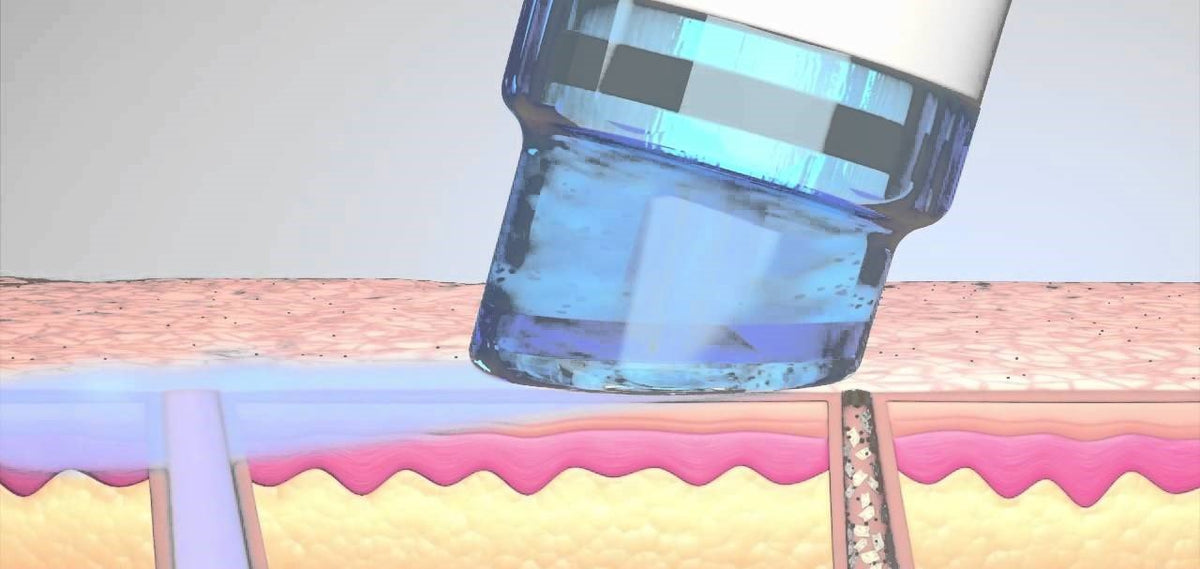 Hydrodermabrasion vs. Microdermabrasion Choosing the Right Skin Care Cavitation Machines